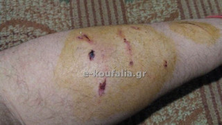 Θεσσαλονίκη: Σκυλί δάγκωσε και τραυμάτισε μαθητή στο Βαθύλακκο